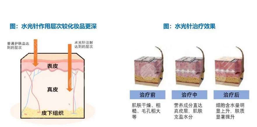 改善干皮能够用哪些医美项目