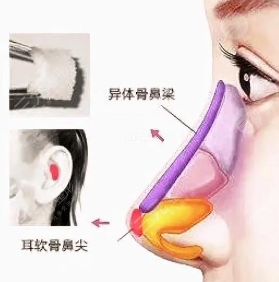 玻尿酸隆鼻后还可以进行假体隆鼻吗