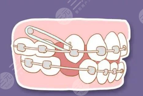 隐形矫正具体过程