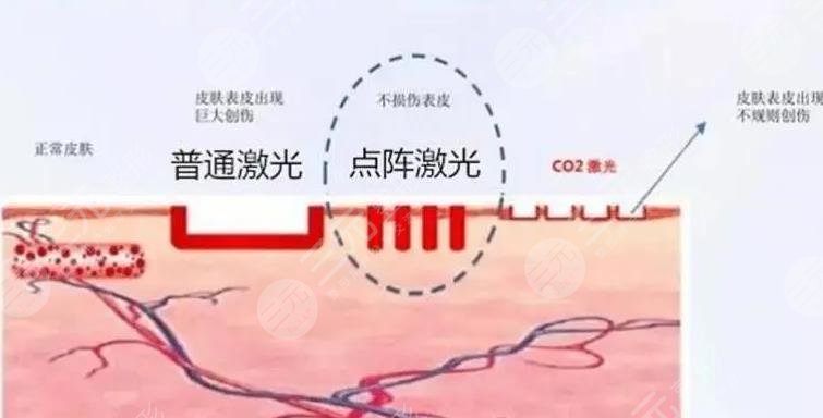 点阵激光可以帮助解决脸上出现的色斑吗