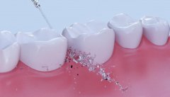 正常洗牙要多少钱一次？5个价格影响因素介绍，有意向的小伙伴看过来！