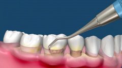 牙周刮治多少钱一次？牙周刮治后多久恢复？价格费用、项目科普一览！