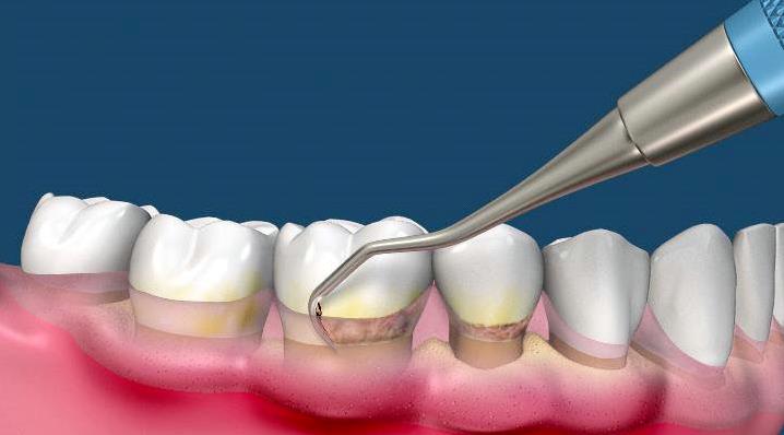 牙周刮治多少钱一次
