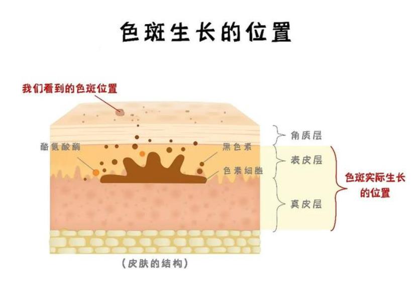 黑脸娃娃能去斑吗