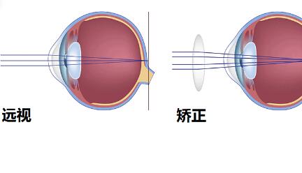 光学矫正