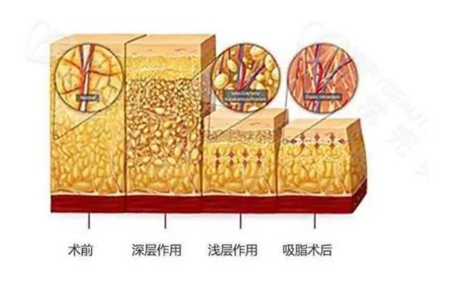 吸脂减肥反弹吗