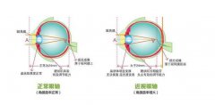 高度近视怎么治疗？2种治疗方法有效解决！附注意事项和饮食建议~