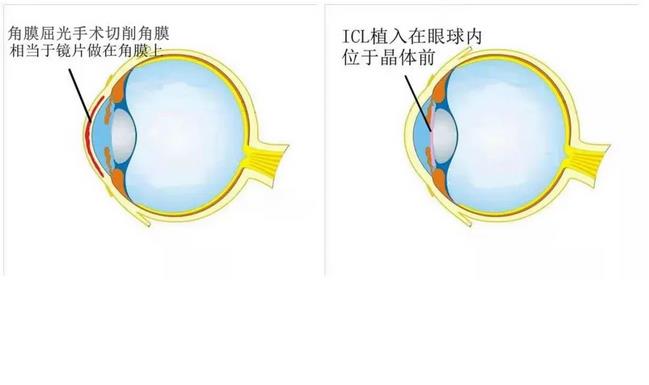 高度近视怎么治疗