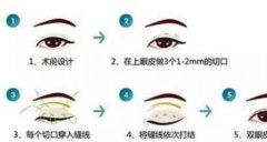 生物焊接双眼皮价格？生物焊接双眼皮有哪些特点！