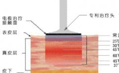 电波拉皮的副作用？来了解一下有哪些副作用吧！