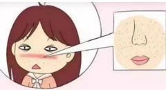 怎么解决毛孔粗大？以下几种对策可以收缩毛孔！