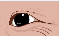 去除眼部细纹的方法有哪些？哪些医美技术改善眼部细纹？