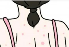 后背长痘是什么原因？小方法教你简单去除后背痘痘！