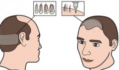 毛发移植的安全性？怎样选择适合自己的植发医院？