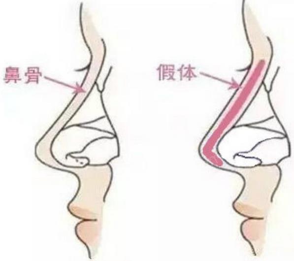 假体隆鼻要注意什么