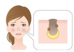 如何收缩脸部毛孔？可以从这几方面入手！附护理方式&注意事项~