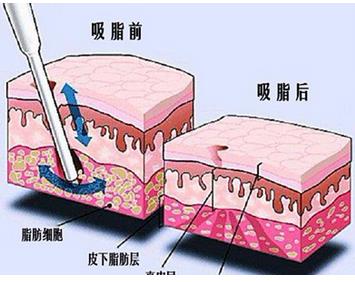 肚子上的赘肉怎么减