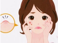 中医祛痘效果如何？中医VS西医？中医祛痘价格多少？