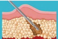 吸脂减肥疼吗？价格贵吗？快速轻松瘦身的办法！