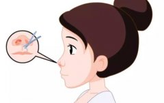 隆鼻失败原因有哪些？这些情况一定要了解！点击收藏