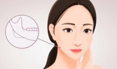 下颌磨骨手术的并发症有哪些？看完这些你还敢做吗？