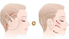 拉皮手术之前需要剃光头吗？术后效果可以维持多久？