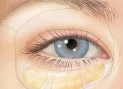 脂肪填充泪沟有哪些注意事项？关于脂肪填充你了解多少？