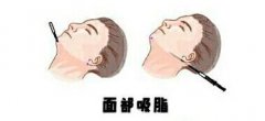 面部吸脂脸部麻木原因是什么？多久会消失？有想法的小伙伴点进来看！