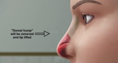 鼻炎患者可以隆鼻吗？做了之后有什么影响吗？