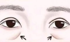 填充泪沟选择自体脂肪还是玻尿酸好？效果一般可以维持多长时间？