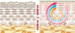 如何减少脸上色斑？光子嫩肤能有效改善斑点嘛？科普篇