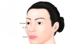 颧骨高怎么办？专业的医美手段有哪些？适用人群有哪些