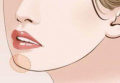 假体垫下巴贵吗？价格区间介绍！假体隆下巴适合人群有哪些？