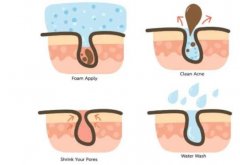 激光能缩小毛孔吗？有哪些其他方式可以缩小毛孔吗？