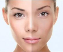 脸上肤色不均匀一块黑一块白怎么办？形成原因揭秘！