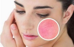 皮肤红血丝怎么改善？正确治疗红血丝的方法盘点！恢复颜值！