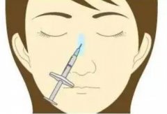 鼻梁打玻尿酸能维持多久？鼻梁会变宽吗？玻尿酸科普小课堂~