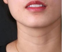 颈纹深怎么办？是什么原因造成的？几个小妙招有效解决！