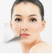 祛痘的小窍门是什么？祛痘小窍门+注意事项分享！有效祛痘！