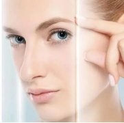 脉冲激光祛斑效果怎么样？带你了解原理|效果|副作用|注意事项