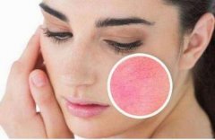 什么可以去红血丝？想要好肌肤这几个要点要牢记！