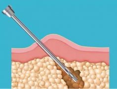 怎么样溶脂吸脂？减肥方式都有哪些？附注意事项