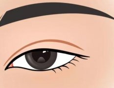 内双可以割双眼皮吗？内双做完双眼皮之后注意事项有哪些？