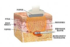 激光溶脂有什么副作用？内附有具体的副作用以及价格分享！