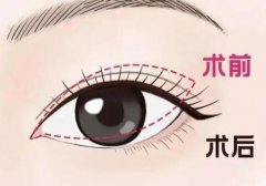 开眼角眼睛会变大吗？内附详细的费用和操作原理分享！