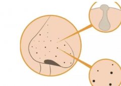 用手挤黑头的危害是什么？留下的坑怎么恢复呢？激光治疗好不好