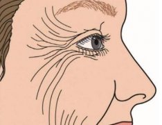 射频除皱能维持多久？原理及注意事项超全盘点！