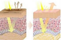 激光美白对有哪些伤害？怎样才能避免激光美白的伤害？