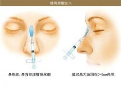 注射隆鼻怎么样？注射的效果可以保持多久？真实效果图