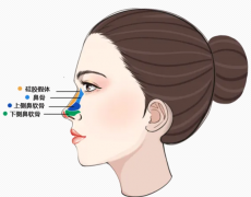 垫鼻梁手术要注意什么？垫鼻梁前后主意好自己的鼻部护理很重要！